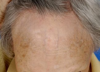 Jak wygląda przeszczep włosów?