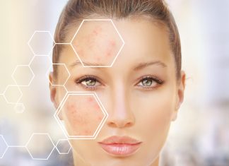 Krem do skóry trądzikowej – jakie są rodzaje? krem do skóry trądzikowej